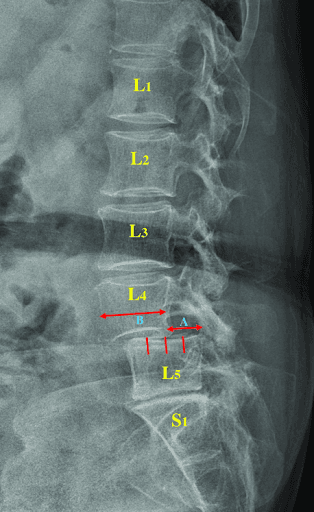 Spondylolisthesis