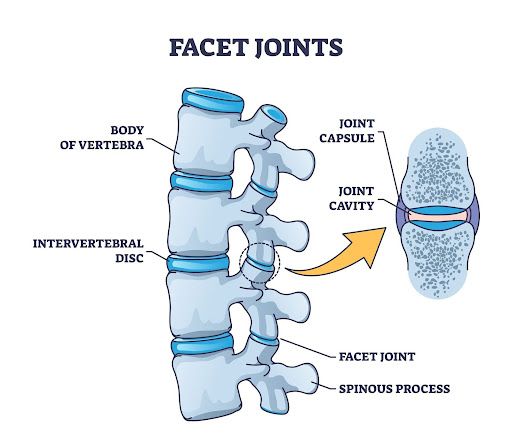 Facet Joint Syndrome