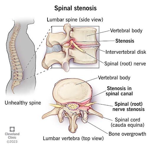 Spinal Stenosis