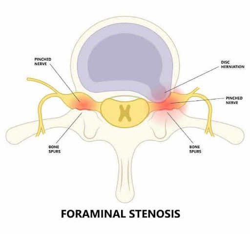 Spinal Stenosis